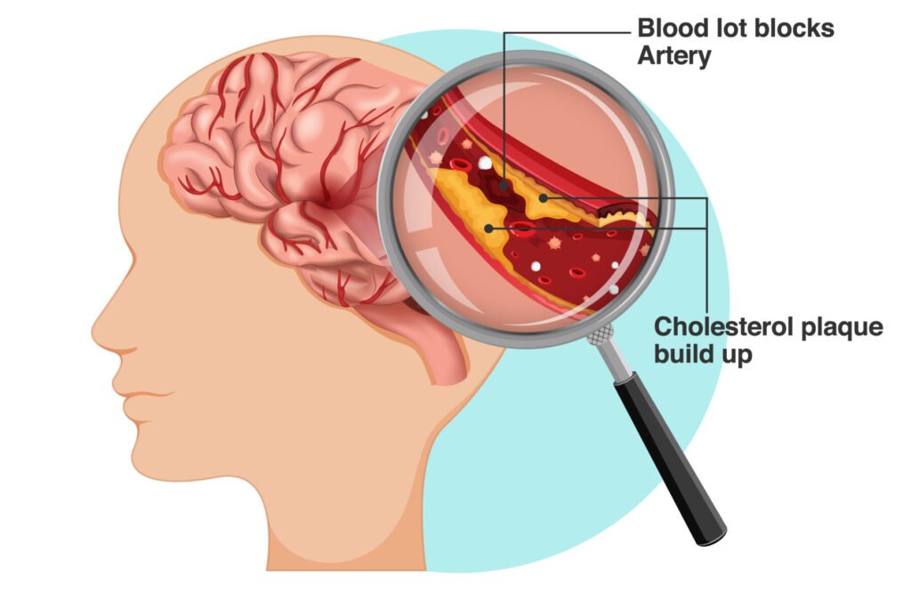Informative poster of Ischemic stroke
