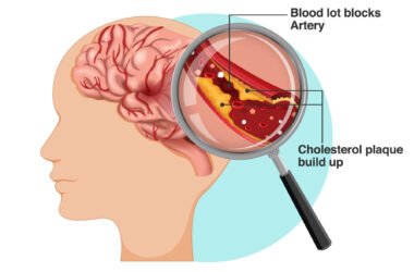 Informative poster of Ischemic stroke